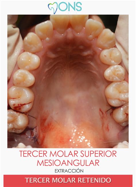 M051 Exodoncia De Tercer Molar Superior Mesioangular ODONTOFLIX Net