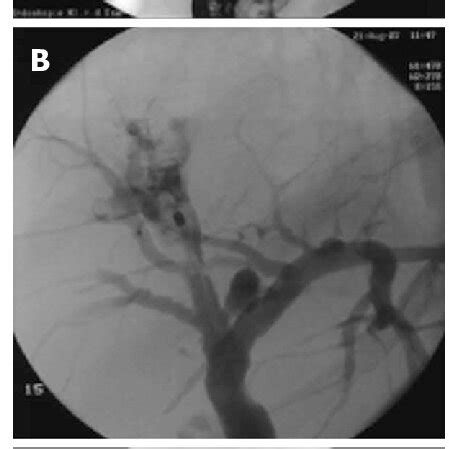 Endoscopic Retrograde Cholangiography Fluoroscopic Images And Video