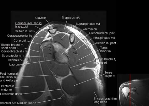 Ver a través de golondrina Rana shoulder joint mri anatomy Cortar Todos