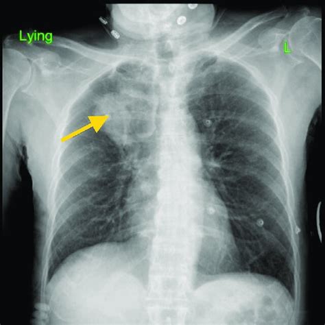 Posterior Anterior Chest X Ray Showing Right Lung Opacity Suggesting A Download Scientific