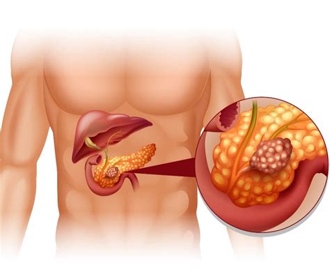 Tumore Neuroendocrino Pancreas cos è sopravvivenza terapia