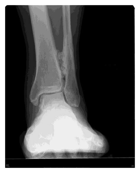 Preoperative Radiographic Findings Anteroposterior A And Lateral B