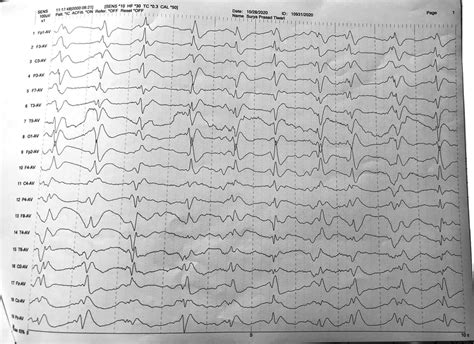 Eeg Pattern With Generalized Slow Waves And Bilaterally Synchronous