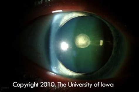 Posterior Polar Cataract. EyeRounds.org - Ophthalmology - The University of Iowa