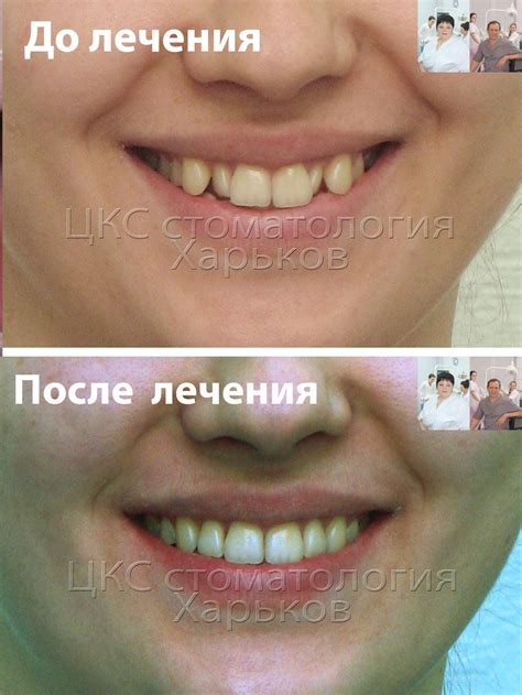 Брекеты до и после