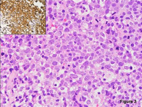 Photomicrograph Showing Histopathology Of The Biopsy Specimen