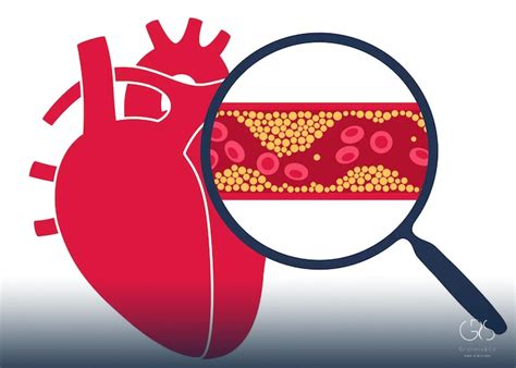 LDL Cholesterol A Comprehensive Guide