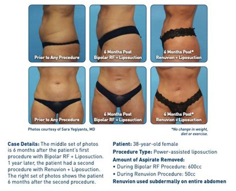 Renuvion J Plasma Skin Tightening Contemporary Health Center