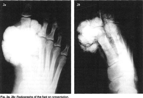 Figure From Tumoral Calcinosis Of The Foot Semantic Scholar