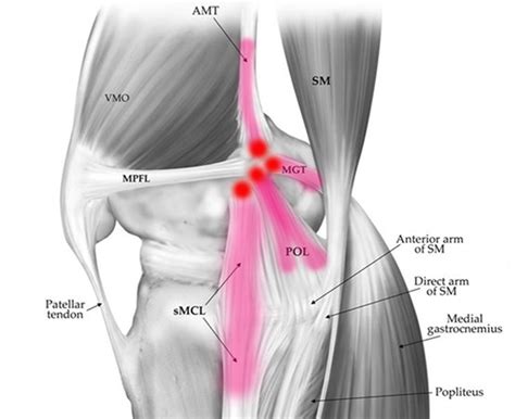 Sports Injury Bulletin Diagnose Treat Pellegrini Steida Syndrome