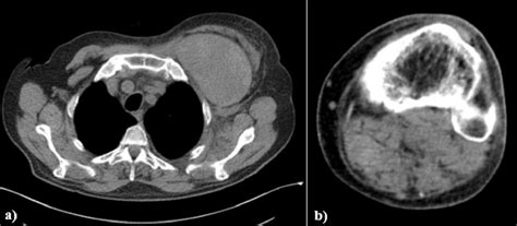 A Thorax CT Scan Evidencing Left Sub Pectoral Hematoma B Computed