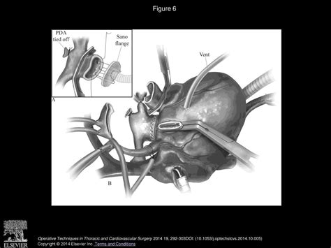 The Norwood Operation With Innominate Artery And Descending Aortic