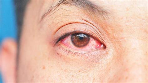 Conjuntivitis cómo identificar los síntomas y tratarla eficazmente