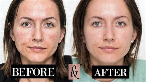 My Microneedling Experience Skin Updates Before After Youtube