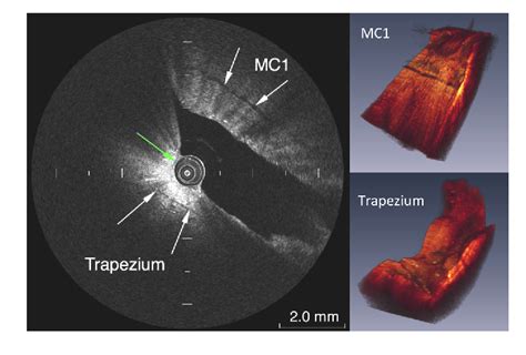 Figure From In Situ Imaging Of Articular Cartilage Of The First