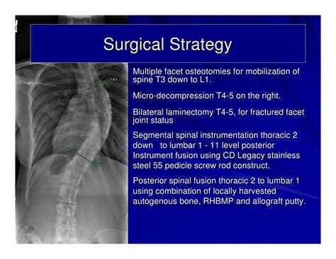 Case Review 4 Adolescent Idiopathic Scoliosis With 61 Degree Curvat