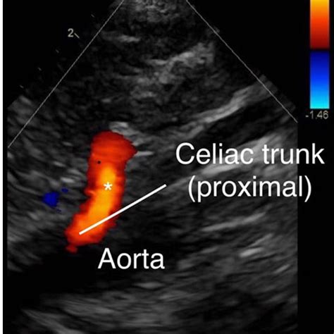 Angiotomography reveal stenosis of the celiac artery. | Download ...