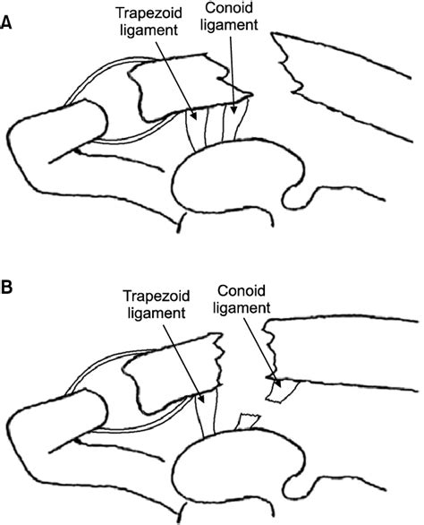 A Neer And Rockwood Classification Of Distal Clavicle Fracture Iia Download Scientific