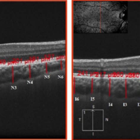 Example Of Subfoveal Choroidal Thickness And Average Submacular