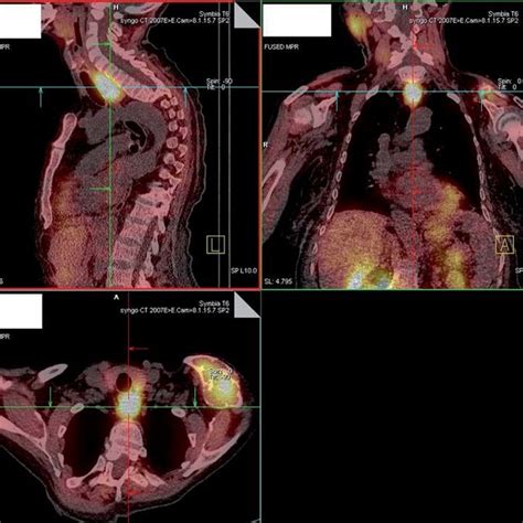 Spect Ct With Mtc Mibi Presenting High Uptake In Primary Parathyroid