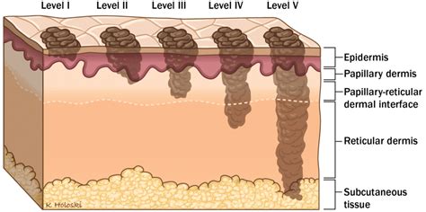 Contratado Capit N Comportamiento Skin Cancer Definition Anatomy Mueble