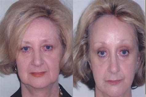 Brow Lift Before And After Photo Gallery Mississauga And Toronto On