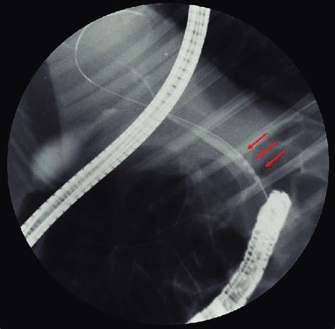 Cholangiography Showing A Radiofrequency Catheter Arrows In The