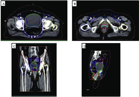 Contouring Volumes Of The Pelvic Lymph Nodes In A The Axial View Download Scientific