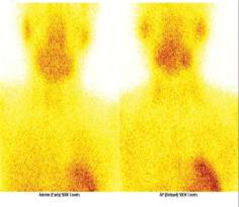 Early Static Image Of Mtc Sestamibi Scan Showing Normal Sized Thyroid