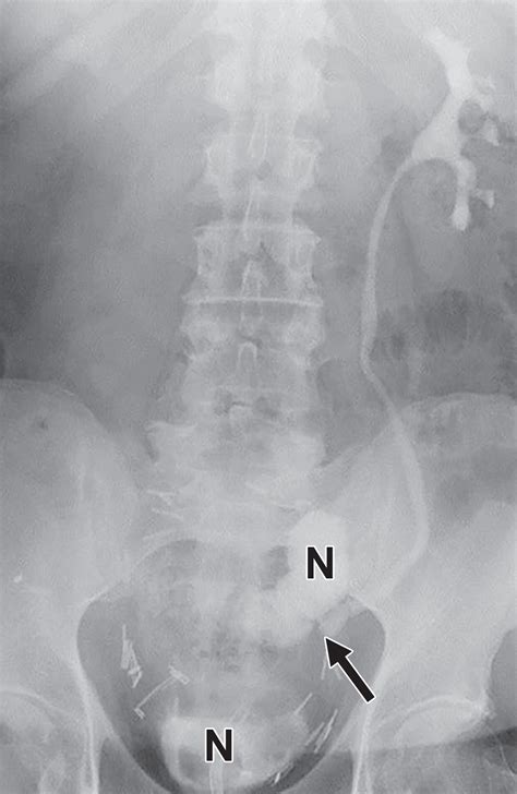 Follow The Stream Imaging Of Urinary Diversions RadioGraphics