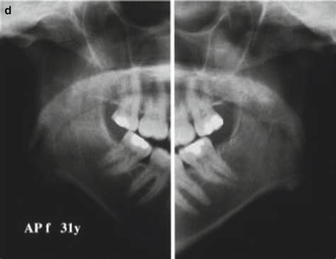 Idiopathic/Progressive Condylar Resorption: An Orthodontic Perspective ...