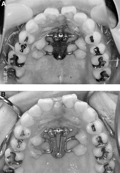 Conventional Bone Anchored Palatal Distractor Using An Orthodontic