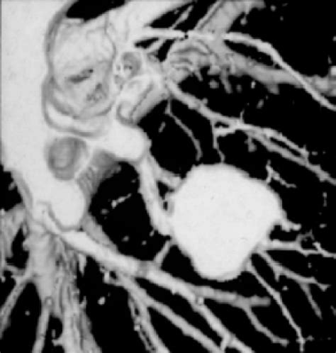 First spiral CT scan of the lung presented at RSNA 1989 (courtesy of... | Download Scientific ...