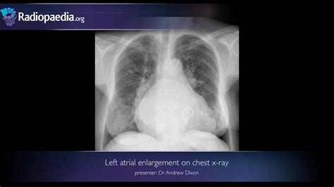 Left Atrial Enlargement X Ray