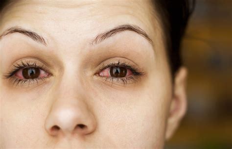 How To Tell The Difference Between Allergies And Pink Eye Lensa Kontak Mata Alami Tetes Mata