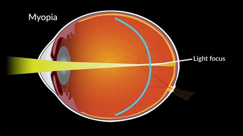 Mixed Results Of Low Dose Atropine For Myopia Eyeworld