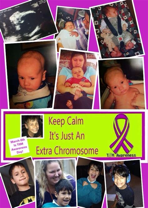 Trisomy 8 Mosaic Syndrome: A Rare and Special Condition