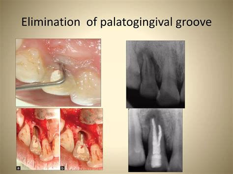Endo - Perio lesions | PPTX