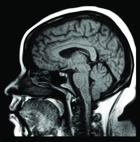 Mri Of T1 Weighted Sagittal View Of The Brain Showing Normal Pituitary