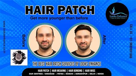 Hair Patch Fixing For Men Non Surgical Hair Replacement Hair Patch Shop Call 9889991666