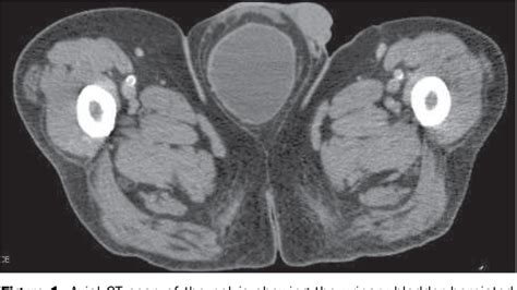 Figure 1 From Incidentally Detected Massive Scrotal Cystocele