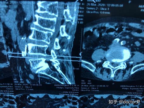 老年性腰椎间盘突出症腰椎1 2度滑脱安全有效的复健训练 知乎