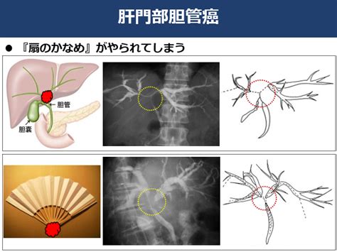 胆道がん｜がんの種類について｜がん研有明病院