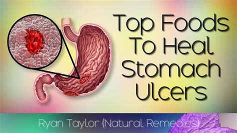 Foods To Cure Stomach Ulcers Natural Remedies Youtube