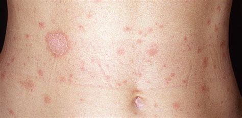 Diagnosis And Treatment Of Lichen Planus Dermatology Laser Surgery