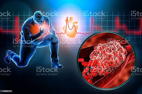 Accidente Cerebrovascular Cardíaco O Ataque Con Coágulo De Sangre O Trombo E Ilustración De