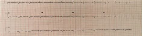 A 12 Lead ECG Taken On First Admission Sinus Rhythm With ST Segment