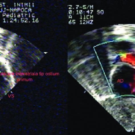 Echocardiography Subcostal Window In B Mode Left And Color Doppler