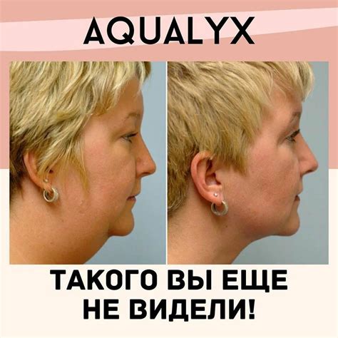 Липолитики для лица: отзывы, фото до и после применения