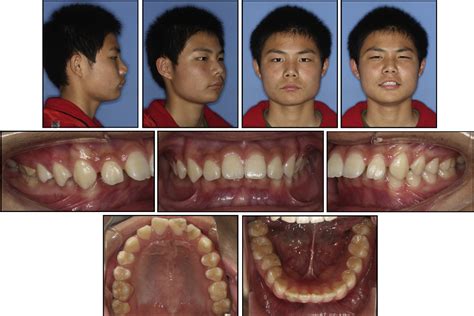 Class Ii Malocclusion